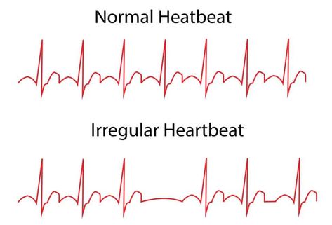 Heart arrhythmias can be harmless at first or they may end up causing your heart to flutter and cause your pulse to speed up.... Learn more Human Cells, Congenital Heart Defect, Heart Palpitations, Congenital Heart, Atrial Fibrillation, Heart Rhythms, Heart Muscle, Coronary Arteries, Heart Surgery