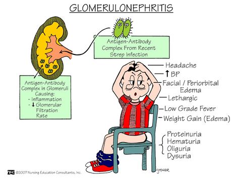 Nursing Mnemonics and Tips: Glomerulonephritis plus more... Nephrotic Syndrome, Nursing Information, Med Surg Nursing, Nursing Study Guide, Nursing Mnemonics, Surgical Nursing, Medical Surgical Nursing, Nursing School Survival, Nurse Rock