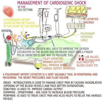 Nursing | Critical | Care | Shock                                                                                                                                                      More Cen Review, Shock Nursing, Cardiac Notes, Nursing Cardiac, Nursing Facts, Telemetry Nursing, Nursing Tools, Cardiogenic Shock, Nurses Gifts