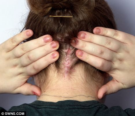 Chiari malformation: Teacher warned she could die if she laughs too hard due to rare brain malformation that puts pressure on her spine | Daily Mail Online Chiari Malformation Type 1, Blurred Vision, Chiari Malformation, Type 1, Daily Mail, Cool Watches, Brain