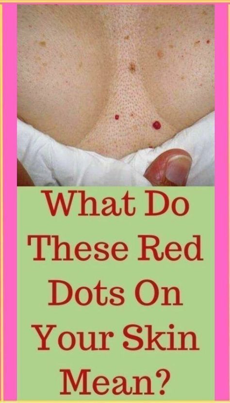 Dry Red Patches On Face, Moles On Face Meaning, Red Moles On Skin, Red Bumps On Face, Face Wrinkles Remedies, Red Moles, Vitamin C Retinol, Blackened Seasoning, What Is Health