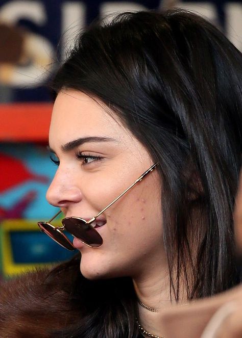 Kendall Jenner Acne, Paris January, Kendall Jenner Icons, Kendall Jenner Face, Kendall Jenner Makeup, Celebrity Acne, Jenner Photos, Kendall Jenner Photos, Acne Treatments