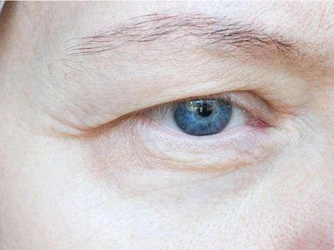 It can make you look younger and also help with your eyesight! The post Hooded eyes, droopy eyelids – what can be done? appeared first on Lifestyle Guide To Moving To & Living in Singapore - Expat Living. Hooded Eye Surgery, Mid Face Lift, Retina Surgery, Saggy Eyelids, Droopy Eyelids, Droopy Eyes, Laser Eye Surgery, Fat Grafting, Upper Eyelid