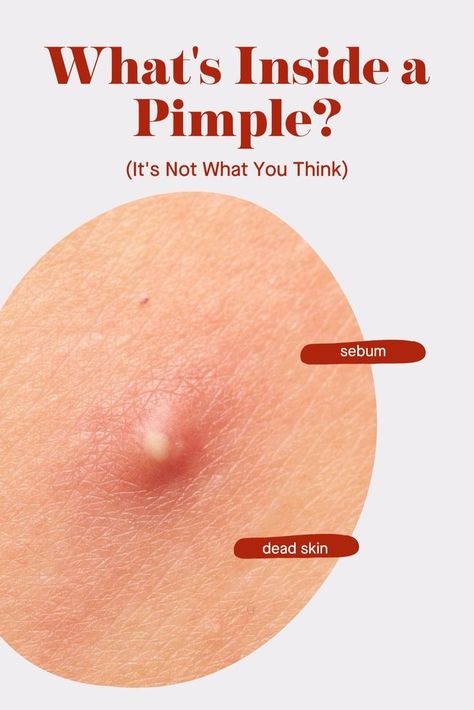 Red Bumps On Face, Pimple Meaning, Hard Pimple, Pimple Inside Nose, What Causes Pimples, Blackheads Removal Cream, Huge Pimple, Inflamed Pimple, Popping Pimples