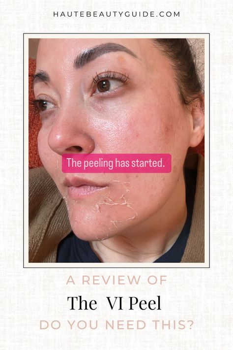 Woman 3 days post VI Peel skin is starting to peel. Vi Peel, Beauty Guide, Join Me, Do You Need, Skincare Routine, Your Skin, Accounting, Beauty Hacks, Skin Care