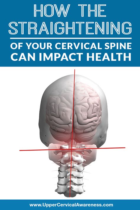 What causes straight neck? How do some people end up with a reverse curve in the neck? How can these conditions impact not only spine pain but also overall health? We will address these questions and direct you to a natural solution. #NeckPainRelief #NeckAcheRelief #NaturalRelief Cervical Spine Exercises, Upper Cervical Chiropractic, Cervical Spondylosis, Middle Back Pain, Spine Pain, Neck Injury, Neck Exercises, Back Pain Remedies, Spine Health