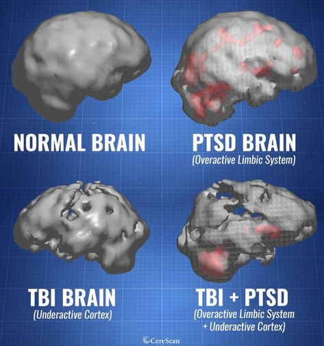 Normal brain Vs.  PTSD & TBI Brains. National Leaders, Hyperbaric Oxygen Therapy, Brain Surgeon, Brain Images, Brain Facts, Brain Anatomy, Oxygen Therapy, Brain Surgery, Brain Damage