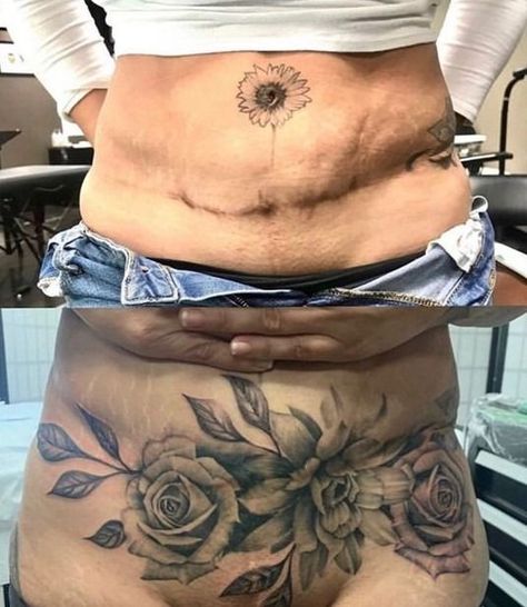 Cover Up Tattoos For Women, Floral Back Tattoos, Scar Cover Up, Scar Tattoo, Tattoo Cover Up, Mommy Makeover, Dope Tattoos For Women, Stomach Tattoos, Floral Tattoo Design