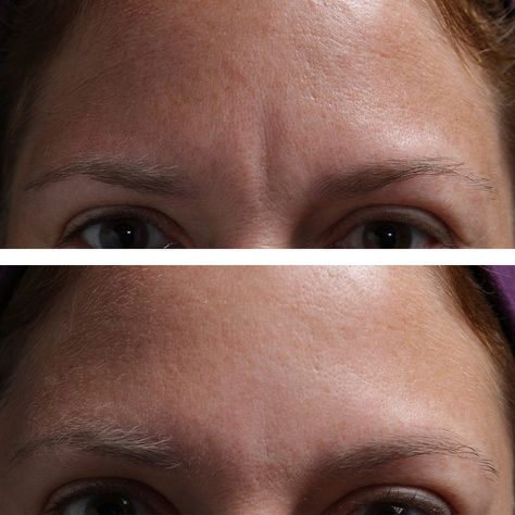 Frown lines? We can help. These vertical lines appear when you smile, laugh, look worried or surprised. As you get older, your skin produces less collagen and your skin loses its elasticity. SilcSkin Brow Pads will hydrate your skin, stimulating the production of collagen, and reducing the appearance of wrinkles. #silcskin #wrinklesnomore #smoothforehead #frownlines #collagenstimulation Frown Lines, Get Rid Of Wrinkles, Hydrate Your Skin, When You Smile, Vertical Lines, You Smile, Anti Wrinkle, Getting Old, Wrinkles