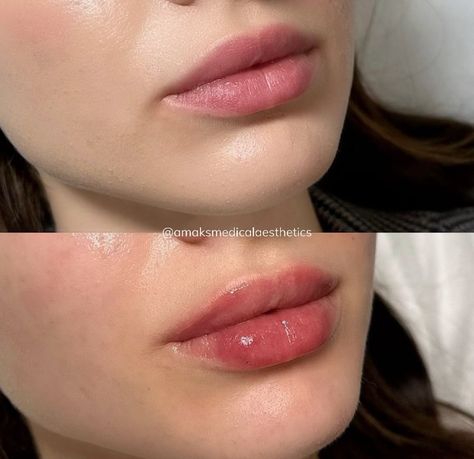 Types Of Lip Fillers, Lips Fillers Shapes, Natural Looking Lip Fillers, Pouty Lip Filler, Lip Filler Natural, 0.5 Ml Lip Filler Before And After, Lip Filler Before And After, Ideal Lips, Lip Filler Shape Ideas