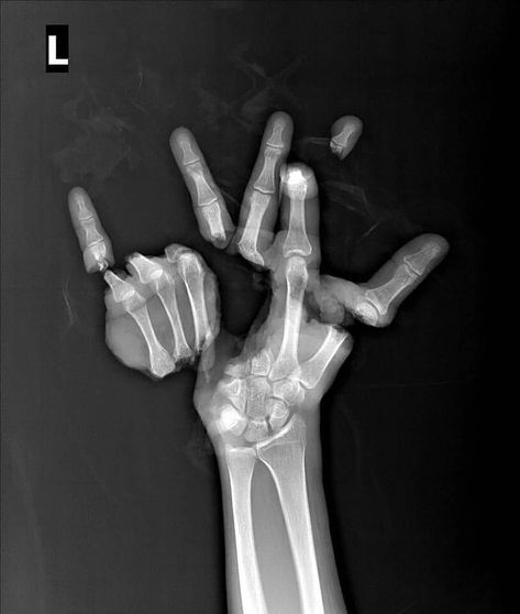 Medicalpedia on Instagram: “⚠️ Trauma caused by an agricultural machine, severing the hand in multiple locations. The patient underwent reconstructive surgery lasting…” Connective Tissue Disorder, Ap Drawing, Medical Pictures, Blood Donor, Famous Monsters, Reconstructive Surgery, X Rays, Video Gif, Connective Tissue