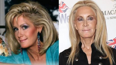 Joan Van Ark is believed to have had every plastic surgery including Botox, fillers, browlift, upper blepharoplasty, rhinoplasty, lip fillers, and facelifts. The actress appears to have tried every measure to keep looking young but all of her efforts have backfired on her because she now looks very uncanny. Joan Van Ark, though she looks extremely unnatural, has never confirmed having plastic surgery. In fact, she often goes out of her way to hide it but that’s not possible now. Joan Van Ark, Knots Landing, Botox Fillers, Stars Then And Now, Lip Fillers, Plastic Surgery, Then And Now, And Now, Surgery