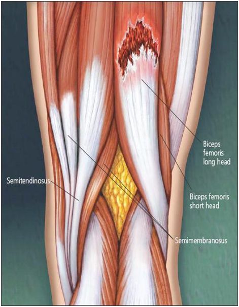 Dance Injuries, Pulled Hamstring, Nerve Exercises, Fascia Stretching, Torn Hamstring, Passive Stretching, Muscle Tear, Hamstring Injury, Back Spasm