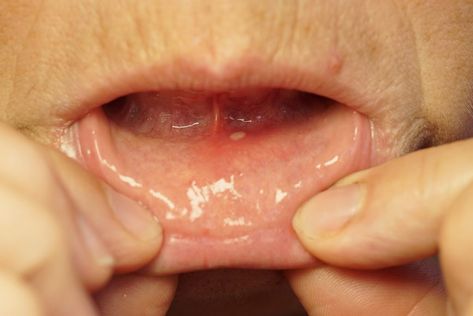 10 Primary Symptoms and Treatments of Dry Mouth Syndrome - Facty Health Dry Mouth Remedies, Bitter Taste In Mouth, Remedies For Dry Mouth, Chest Infection, Dry Mouth, Gum Health, Luxury Beauty, Healthcare Professionals, Home Remedies