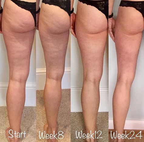 Leg progress Leg Transformation, Shape Transformation, Benefits Of Squats, Diets For Women, Diet Keto, Transformation Body, Weight Management, Personal Training, Fitness Inspo