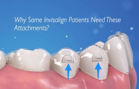 Invisalign Tips And Tricks, Invisalign Before And After, Invisalign Aesthetic, Invisalign Attachments, Invisalign Hacks, Invisalign Aligners, Dental Bonding, Braces Tips, Nose Picking