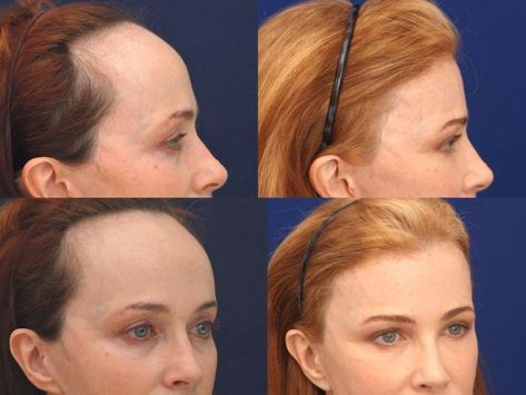 A plastic surgeon who performs forehead reduction surgeries to lower hairlines shares before and after photos, and what to expect Forehead Reduction Surgery, Forehead Reduction, Female Pattern Baldness, Course Hair, Reduction Surgery, Pattern Baldness, Big Forehead, Facial Plastic, Normal Hair