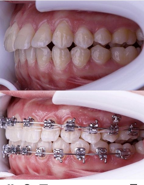 Braces Journey, Adult Braces, Dental Braces, Lionel Messi, Braces, Facial