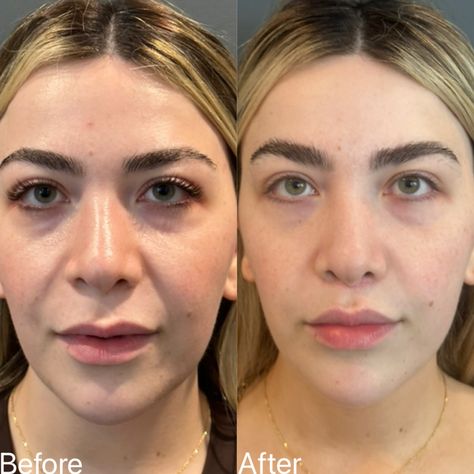 I had the absolute pleasure of seeing this beautiful bride-to-be for her 2 month follow-up. 👰‍♀️ We did a subtle upper lip lift to balance out her facial features and reveal more of her natural volume. The scar is a little pink as expected in this stage of healing, and will keep improving over the next few months. We are so excited for her next big chapter! #liplift #subnasalliplift #upperliplift Upper Lip Lift, Lip Lift, Upper Lip, Facial Features, Beautiful Bride, So Excited, The Next, Facial, Lips