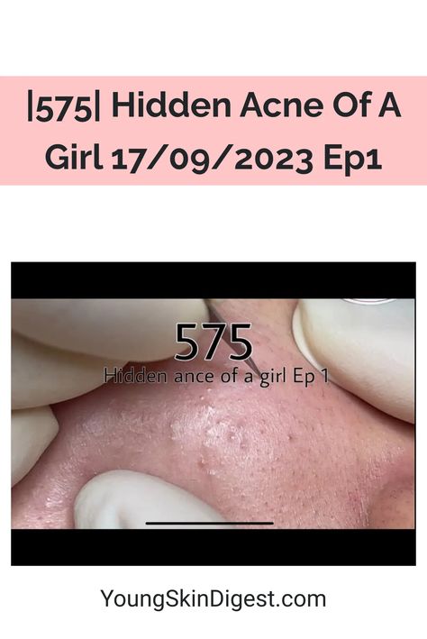 |575| Hidden Acne Of A Girl 17/09/2023 Ep1 Acne Recipes, Bad Acne, Cystic Acne, Itchy Skin, Skin Issues, Skin Healing, Radiant Skin, Skin Health, Glowing Skin