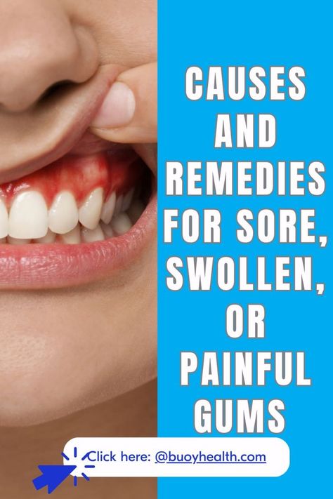 Check your symptoms and clarify your options for care. The Buoy A.I. health assistant guides you on your way to well, the moment you feel sick..
#swollengums #swollengumsremedy Sore Gums Remedy Natural, Mouth Ulcer Remedies, Gum Infection Remedies, Sore Gums Remedy, Swollen Gums Remedy, Gum Sores, Ulcer Remedies Mouth, Blood Blister, Remedies For Dry Mouth