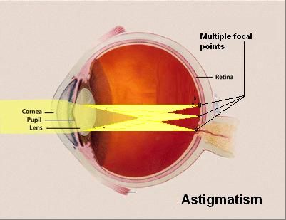 Eye Astigmatism | Astigmatic | Astigmatism vision | Astigmatism ... Astigmatism Vision, Blurred Vision, Blurry Vision, Vision Problems, Eye Surgery, Light Rays, Greek Words, Dry Eyes, Pink Eyes