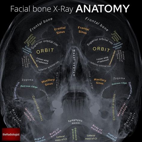 the Radiologist | Radiology on Instagram: "Occipito-mental radiograph of the facial bones⁣⁣ ⁣⁣ 👨🏽‍💻The facial bone X-ray is being replaced with CT in many places but in some places around the world remains first line in facial trauma. It can be a confusing film to assess with so much opportunity for composite shadowing - it is important to employ a robust system to assess for fractures⁣⁣ ⁣⁣ 👨🏽‍💻In nasal bone fractures (most common), mandible, zygoma and orbital fractures we cover over 98% Radiography Student, Radiology Schools, Medical Radiography, Radiologic Technology, Radiology Student, Radiology Technician, Radiology Imaging, Facial Bones, Radiology Tech