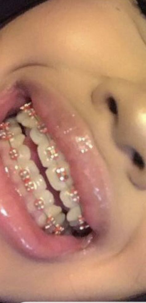 Dental Braces Colors, Braces Colors Combinations, Pink Braces, Cute Braces Colors, Pretty Teeth, Braces Tips, Getting Braces, Cute Braces, Brace Face