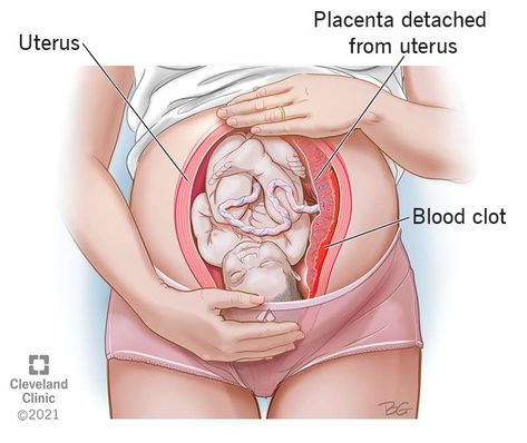 Placental Abruption: Symptoms, Causes & Effects On Baby Placenta Abruption, Fetal Movement, Contractions Labor, Feeling Faint, Amniotic Fluid, Gestational Age, Premature Birth, Unborn Baby, Pelvic Pain