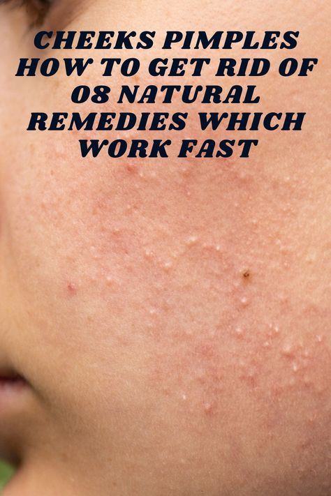 Cheeks Pimples How To Get Rid Of 08 Natural Remedies Which Work Fast #acne #pimples #pimplesremedies #acneremedies #skincarediy. https://whispers-in-the-wind.com/combatting-pimples-under-the-skin-expert-tips-and-product-recommendations/?46 How To Get Rid Of Papules, Small Pimples On Face Remedies, How To Get Rid Of Bumps On Cheeks, How To Get Rid Of Small Pimples On Face, How To Get Rid Of Pimples Fast, Small Pimples On Face, Cheek Pimples, Pimple Remedies, Deep Pimple