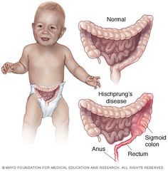 Hirschsprungs Disease, Sigmoid Colon, Nursing Information, Large Intestine, Pediatric Nursing, Mayo Clinic, Medical Education, Learning Tools, Nursing School