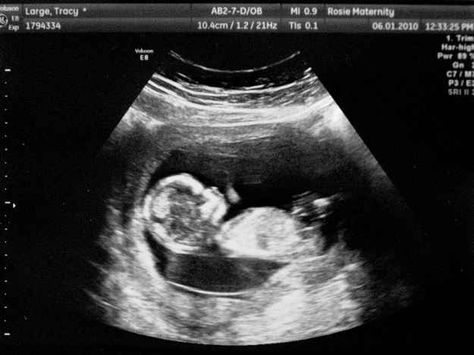 The 12-week scan, when you see your real, actual child for the first time is the most awe-inspiring thing you'll witness. | The 19 Stages Of Pregnancy From A Man's Perspective 12 Week Ultrasound Pictures, 12 Weeks Pregnant Ultrasound, Ultrasound Pictures Gender, Boy Ultrasound Pictures, Boy Ultrasound, 12 Week Ultrasound, 12 Week Scan, Baby Ultrasound Pictures, 11 Weeks Pregnant