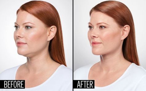 Scroll through to see how Adra Fenstermaker had a dermatologist eliminate her double chin! Double Chin Surgery, Face Fat Loss, Botox Before And After, Laser Clinics, Reconstructive Surgery, Cosmetic Procedures, Double Chin, Plastic Surgeon, Cosmetic Surgery