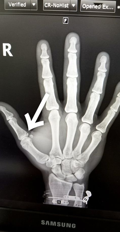 X-ray of ski slopestyle Gus Kenworthy's broken thumb. Skeleton Hands Drawing, Blitz Tattoo, Skeleton Drawings, Sharpie Tattoos, Hand Doodles, Theme Tattoo, Skeleton Hand Tattoo, Human Drawing, Anatomy Sketches