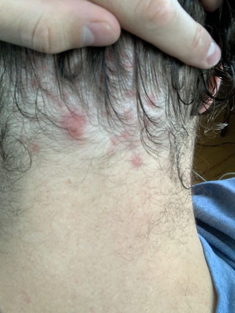 Whats the deal with back of neck hairline pimples? What could cause them? How do I get rid of them? More in comments...- ThorGift.com - If you like it please buy some from ThorGift.com Back Of Neck Hairline, Neck Hairline, Skin Rash On Face, Neck Pimples, Pimple Causes, Clear Skin Routine, Pimples Remedies, Acne Help, Back Of Neck Tattoo