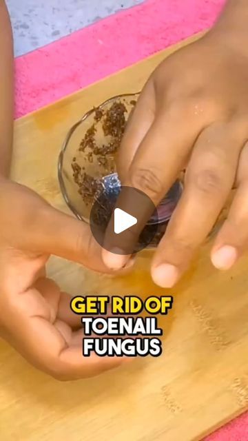 Fingernail Fungus Remedies, How To Get Rid Of Fungal Toenails, Thick Toenail Remedy How To Get Rid, Toe Nail Fungus Home Remedy, Missing Toenail Solution, Home Remedies For Toenail Fungus, Tea Tree Oil For Nail Fungus, Toenail Fungus Essential Oils, Toenail Removal