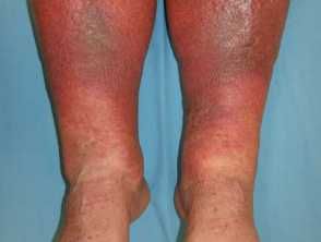 Varicose Veins Essential Oils, Autoimmune Disease Symptoms, Wound Care Nursing, Leg Ulcers, Varicose Vein Remedy, Leg Veins, Hyperbaric Oxygen Therapy, Venous Insufficiency, Swollen Legs