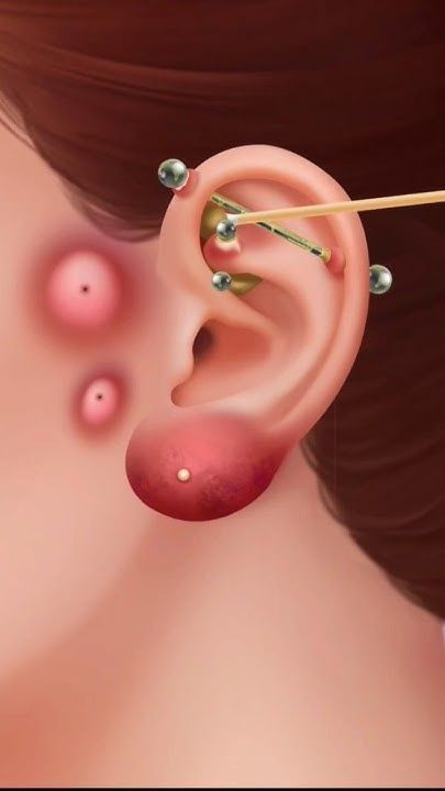 How To Clean Your Ear Piercing, Clean Ear Piercings, Infected Piercing, Piercing Cleaning, Infected Ear Piercing, What Causes Pimples, Blackheads On Cheeks, Ear Pimple, Prevent Pimples