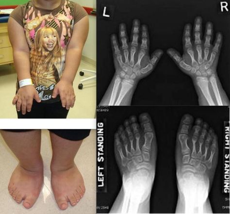 MED - short upper arms with short and stubby fingers & toes - radiograph shows Brachydactyly (shortness of the fingers), brachymetacarpals, small and irregular carpal bones and distal radial epiphysis. Carpal Bones, Stubby Fingers, Upper Arms, Bones