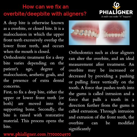 How can we fix an overbite/deepbite with aligners?  Often, a deep bite is treated either with braces or clear aligners. Invisible aligners are an option for correcting an overbite without braces. #openbite #deepbite #overbite #alignerattachment #alignercases #painless Invisible Aligners, Front Teeth, Clear Aligners, Dental Problems, Braces, How Can, Canning