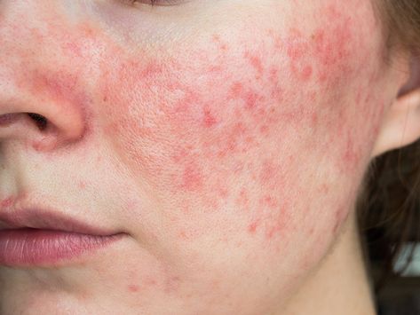 Everything You Need To Know About Rosacea | Chatelaine Acne Vulgaris, Acne Skincare Routine, Skin Clinic, Remove Acne, Holistic Healing, Skin Care Acne, Dermatology, Skin Problems, Skin Conditions