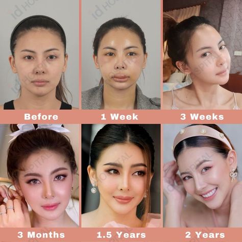 South Korean Plastic Surgery, Beauty Surgery, Botox Injection Sites, Injection Sites, Change Appearance, V Line Surgery, Botox Injection, Plastic Surgery Korea, Korean Plastic Surgery