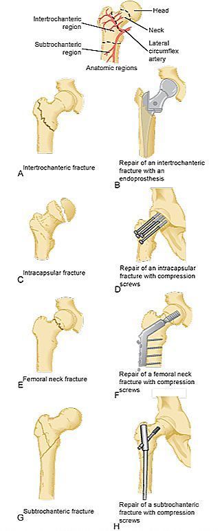 intertrochanteric fracture ROSH - Google Search Surg Tech, Orthopedic Nursing, Surgical Technician, Radiology Student, Hip Fracture, Surgical Technologist, Surgical Nursing, Medical School Essentials, Orthopedic Surgery