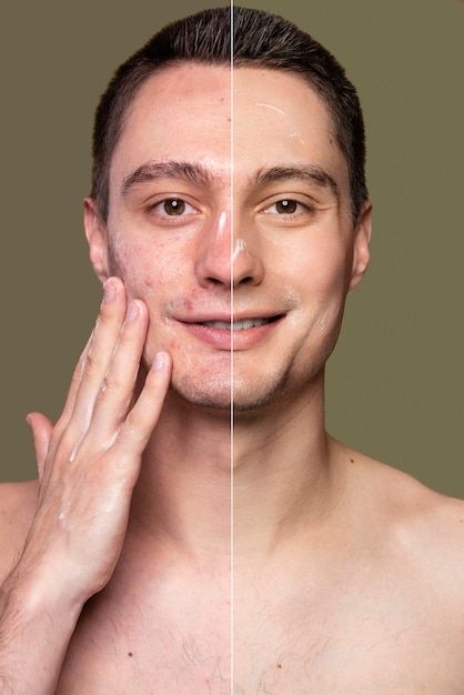 Before and after portrait of young man r... | Free Photo #Freepik #freephoto #retouch #man-skin #man-face #male-face Male Acne, Facial Before And After, Before And After Acne, Acne Men, Blind Pimple, Mens Facial, Pimples On Face, Facial Aesthetics, How To Get Rid Of Pimples