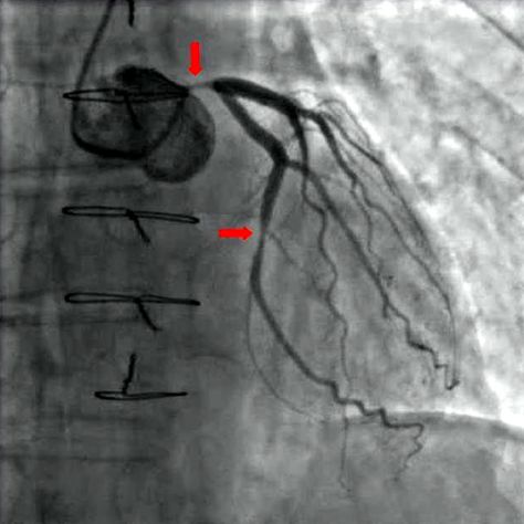 Coronary Angiography | Heart | Blood/Heart/Circulation --- https://neejad.notion.site/Coronary-Angiography-1b7cac5fec874dee82ee4442a696d82c --- NOTE: Image Attribution (when applicable) is available in Notion Link --- #Neejad #LaymanMedicine #MedEdForAll #Notion #ElevenLabs Heart Circulation, Blood Heart, Spaced Repetition, Cardiology, Start Now, Medical Students, Medical School, Video Tutorials, Study Guide