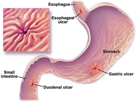 Foods Suitable For Stomach Ulcer - HubPages Food For Stomach Ulcers, Ulcer Symptoms, Ulcer Diet, Digestive Juice, Stomach Ulcers, Stomach Pain, Essential Oil Uses, Acid Reflux, Feeling Sick