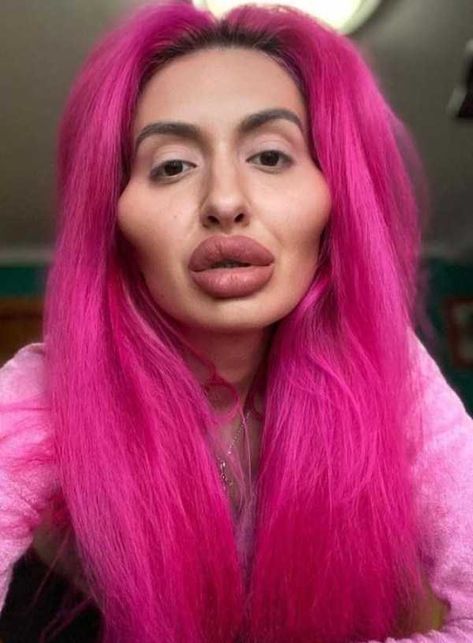 Extreme Plastic Surgery, Bad Plastic Surgeries, Plastic Surgery Fail, Plastic Surgery Gone Wrong, Botox Lips, Bad Fashion, Celebrity Plastic Surgery, Under The Knife, Cosmetic Procedures