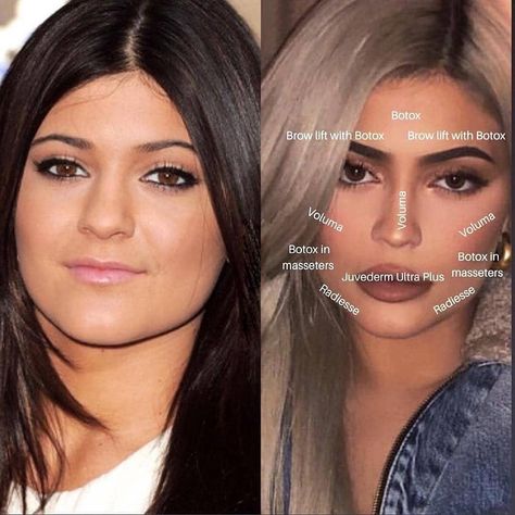 Goals Aesthetics on Instagram: “Well hello there Ms. Jenner, 😘 you’re looking fabulous while showing off your fantastic fillers! 💉 Are you dolls curious about the…” Kylie Jenner Plastic Surgery, Face Plastic Surgery, Botox Brow Lift, Cosmetic Fillers, Face Fillers, Cheek Fillers, Facial Fillers, Facial Aesthetics, Facial Plastic Surgery