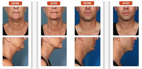 Non Surgical Facelift, Chemical Peels, Cuyahoga Falls, Face Scrub Homemade, Anti Aging Beauty, Skin Secrets, After Pictures, Peeling Skin, Anti Wrinkle Cream