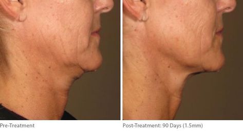 Thermage vs. Ultherapy: What is the Difference? Loose Neck Skin, Neck Lift Surgery, Tighten Neck Skin, Neck Surgery, Neck Lift, Skin Tissue, Loose Skin, Improve Skin Texture, Double Chin